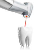 BENEFITS OF LASER DENTISTRY