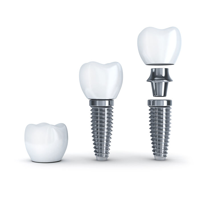Implant Restoration - Dental Services